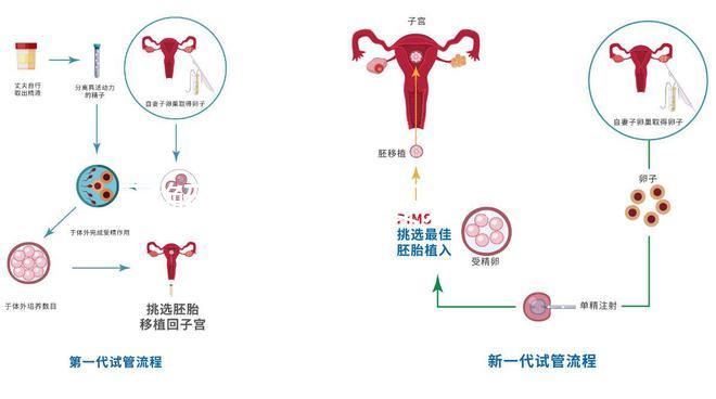 了解二代試管嬰兒:技術原理與優勢解析