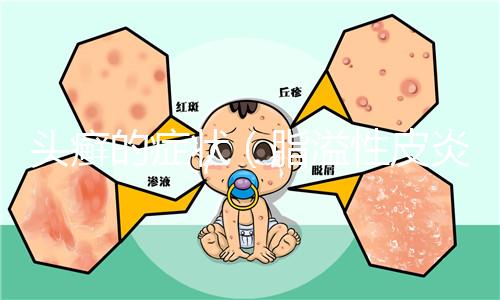 頭癬的癥狀(脂溢性皮炎和頭癬區(qū)別)