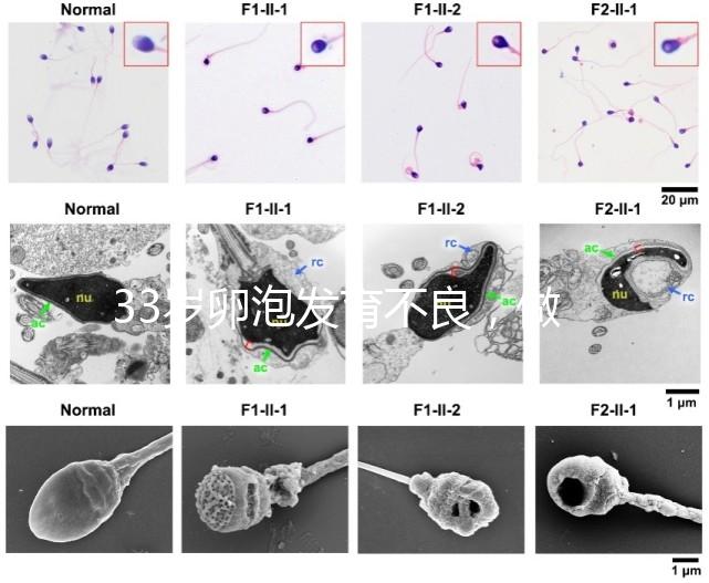 33歲卵泡發育不良，做試管黃體期促排方案失敗怎么辦？